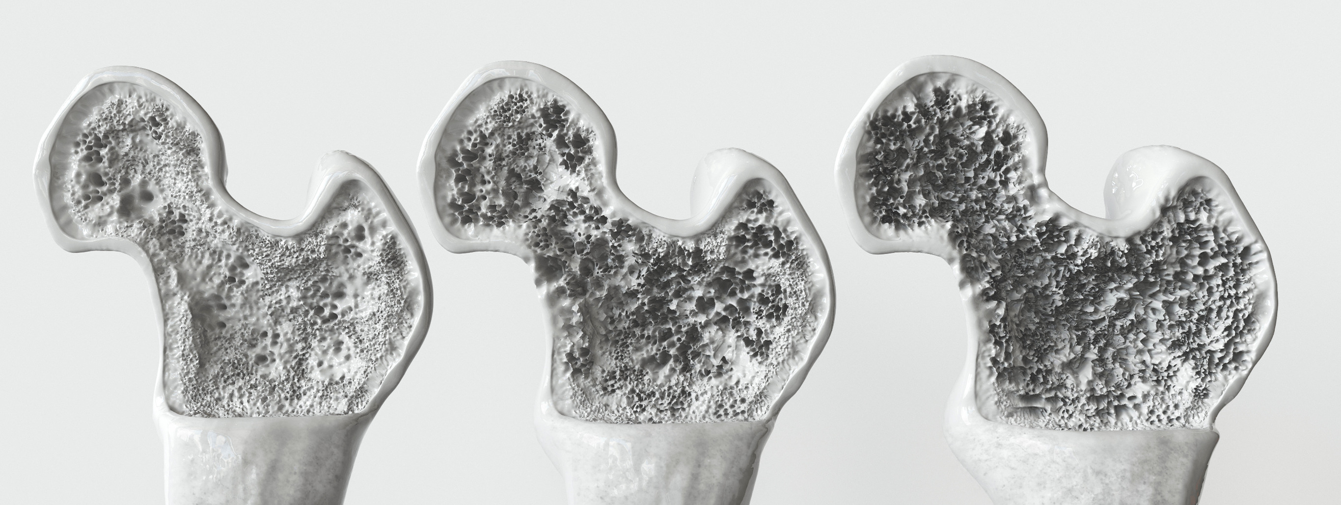Zwakke botten vs dementie