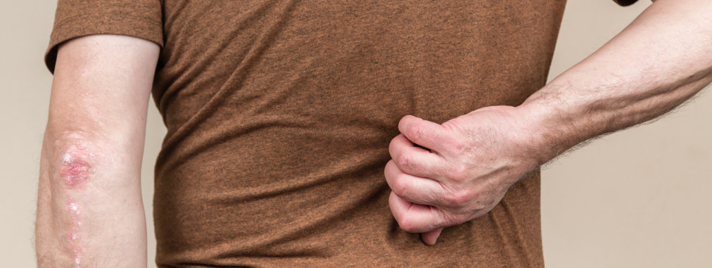 Psoriasis, hart- en vaatziekten en trombose