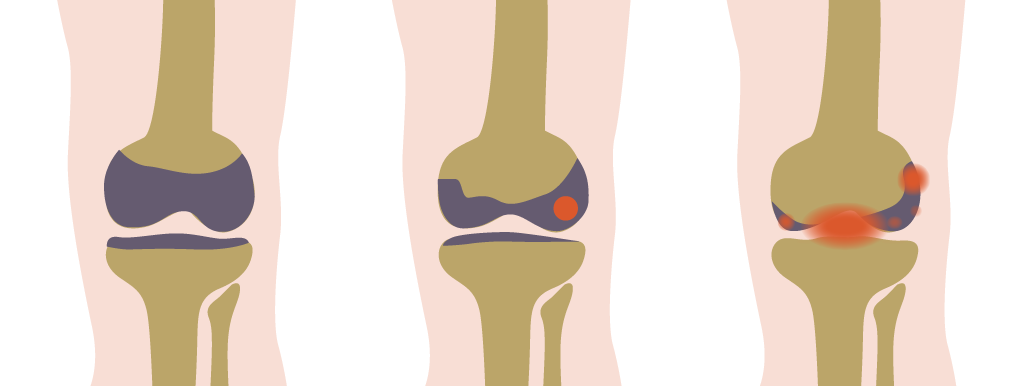 Leefstijlinterventie blijft helpen bij artrose