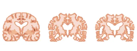 Mediterrane versus westerse voeding op beginnende dementie