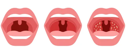 Verzorg je amandelen met natuurlijke middelen