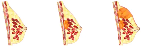 Ketogene antikankervoeding