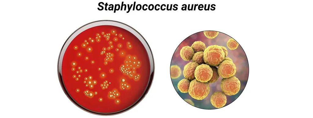 Probioticum vermindert kolonisatie Staphylococcus aureus