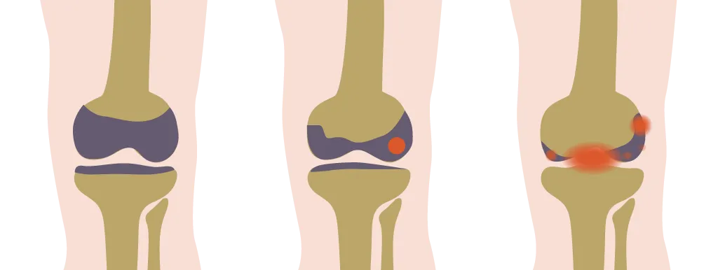 Leefstijlinterventie blijft helpen bij artrose