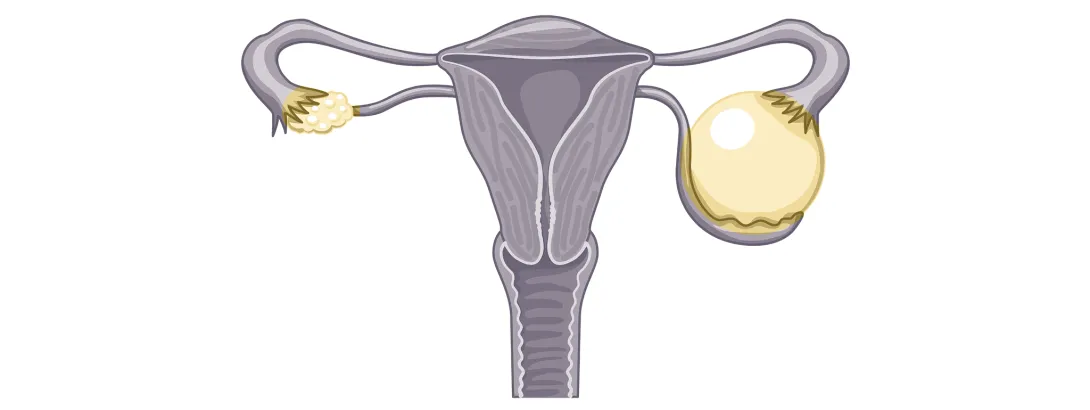 PCOS